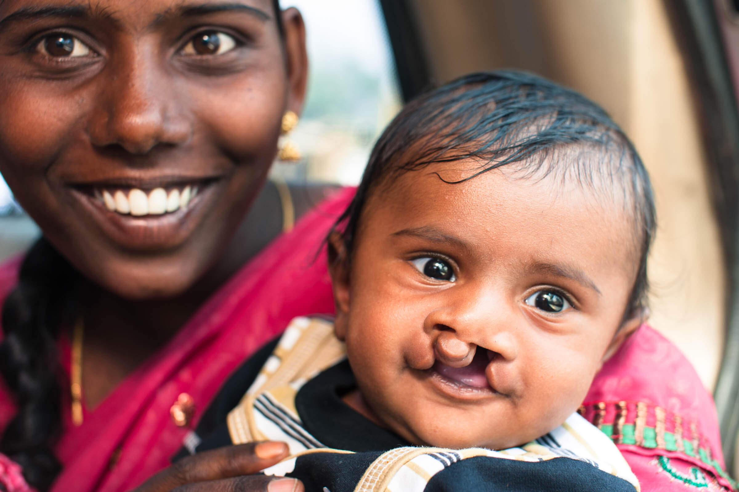 Cleft Kind Indien 100