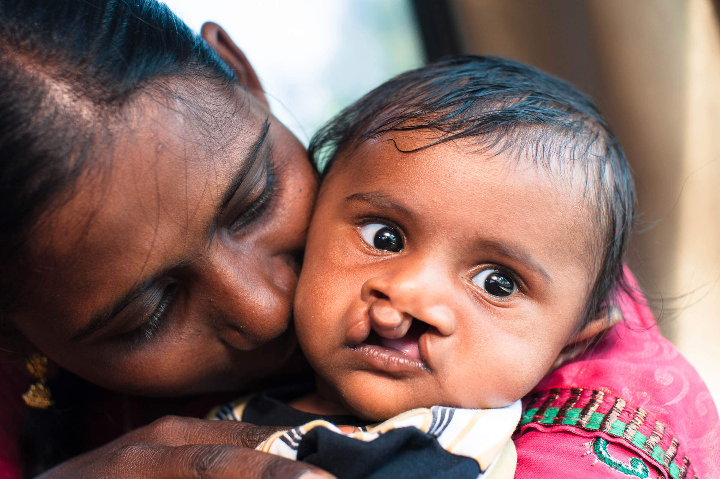 Cleft Kind Indien 103