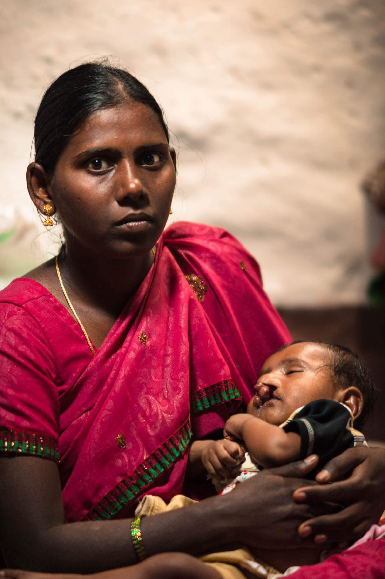 Cleft Kind Indien 111
